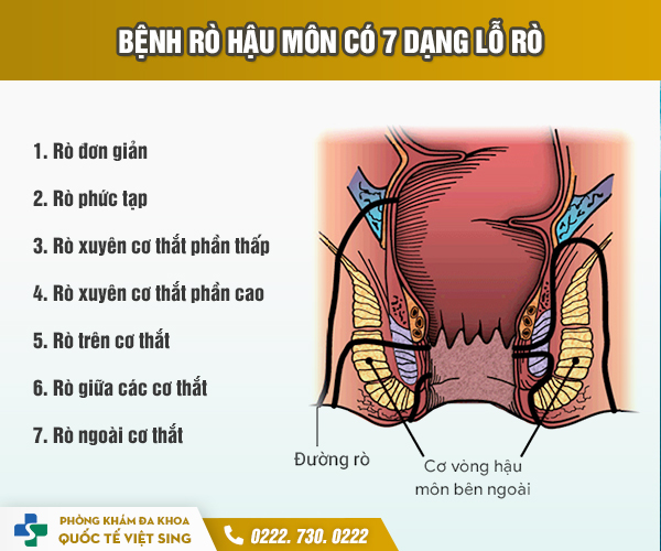 https://benhtribacninh.com/wp-content/uploads/2023/05/cac-loai-ro-hau-mon.jpg