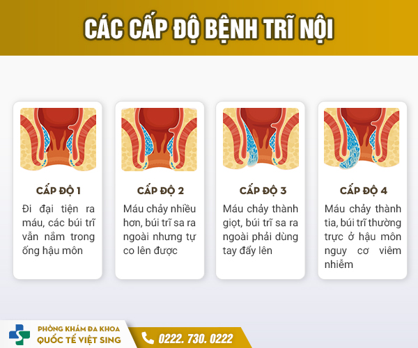 https://benhtribacninh.com/wp-content/uploads/2023/05/cap-do-benh-tri-noi.jpg
