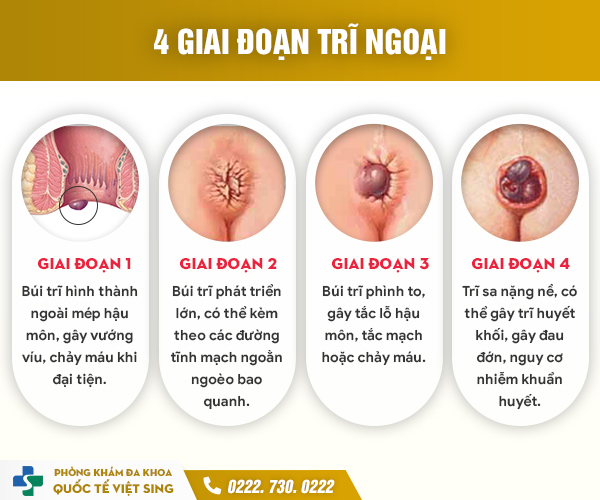 Trĩ ngoại: Từ dấu hiệu ban đầu đến giải pháp điều trị toàn diện