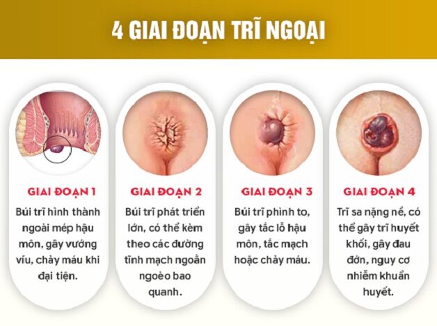 Chữa và điều trị trĩ ngoại tại Việt Sing: Hiệu quả vượt trội, an tâm tuyệt đối