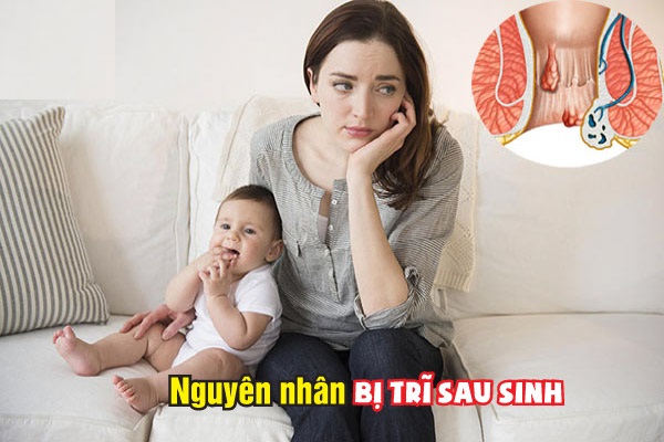 Bị trĩ sau sinh – Đừng lo, đã có Việt Sing đồng hành