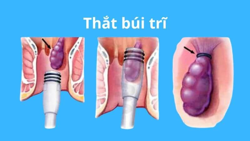 https://benhtribacninh.com/wp-content/uploads/2025/08/that-bui-tri2.jpg