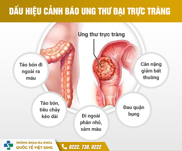Đi Ngoài Ra Máu Nhiều Cẩn Thận Mắc Ung Thư Trực Tràng