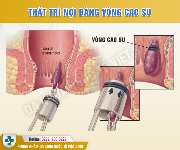 Liệu Thắt Búi Trĩ Bằng Vòng Cao Su Có An Toàn Không?