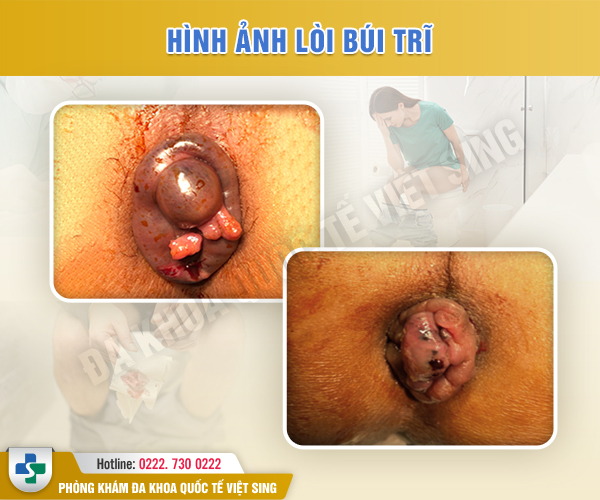 Lòi Búi Trĩ Cách Chữa Đúng Cách cùng bác sĩ chuyên khoa