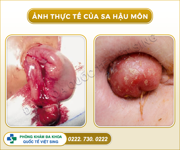 Thưa bác sĩ! Tôi bị sa trực tràng phải làm sao để hết bệnh?